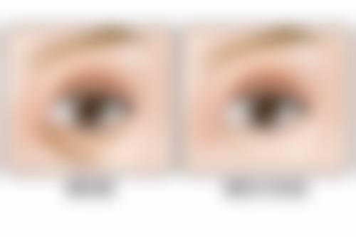 手术治疗重度的点痣后疤痕增生