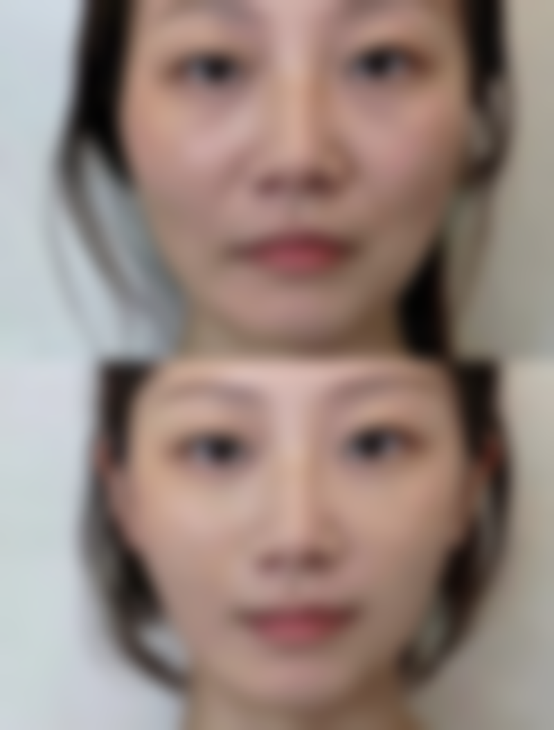 大腿吸脂后的运动注意事项