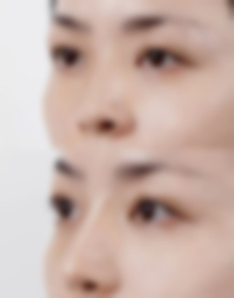 大腿吸脂后要注意什么？从伤口护理到饮食运动，全方位科普助你术后快速恢复！ 