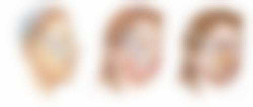 医美手段祛除黑眼圈眼袋