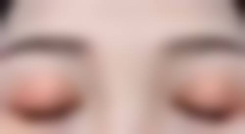 全切双眼皮修复的注意事项