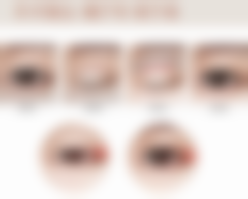 全切双眼皮太宽太深的修复方法