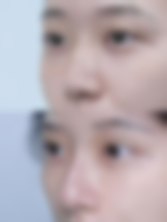 隆胸取出假体一般需要多长时间？这受手术方式、假体位置等因素影响，通常1 - 3小时左右！ 