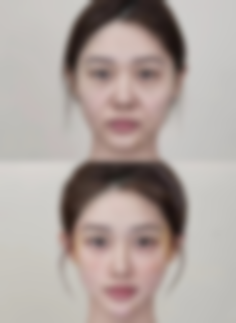 怎么简单快速消除眼袋？非手术与手术方法大揭秘，助您轻松告别眼袋困扰！ 