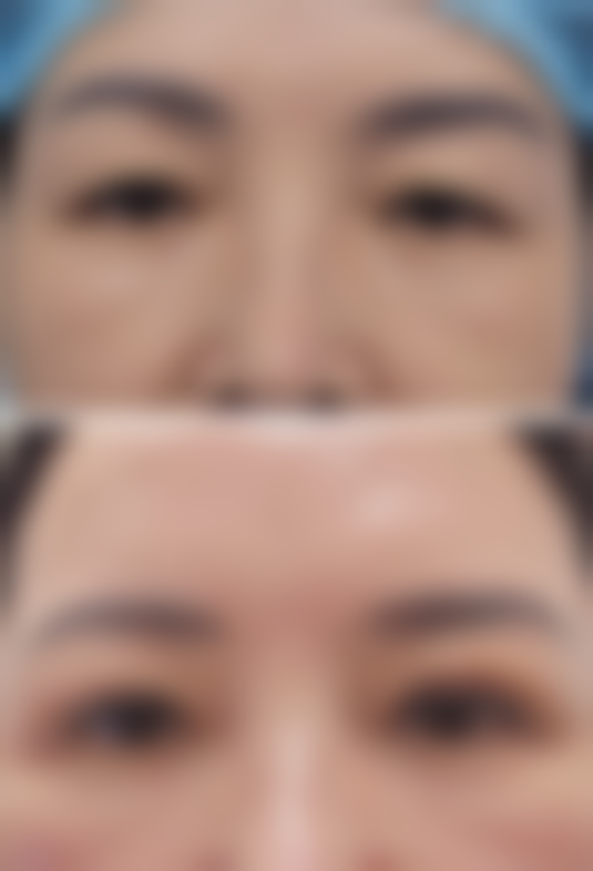 手术修复割的双眼皮疤痕