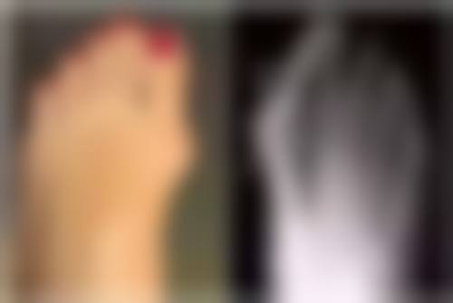 四十多岁做双眼皮的修复情况