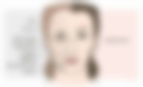 肿眼泡割双眼皮是不是要抽脂？需看脂肪堆积程度，多数建议抽脂，部分情况可单独割！ 