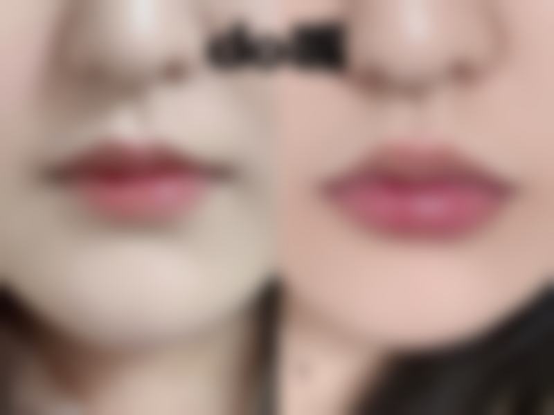 瘦脸针能打苹果肌吗？多位医生观点不一，有的认为可综合评估，有的则明确表示不可以！ 