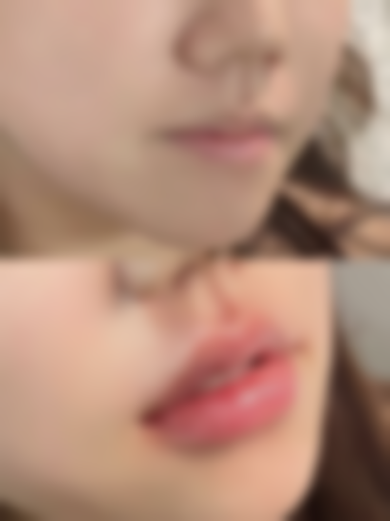 不同程度烧烫伤疤痕的修复情况