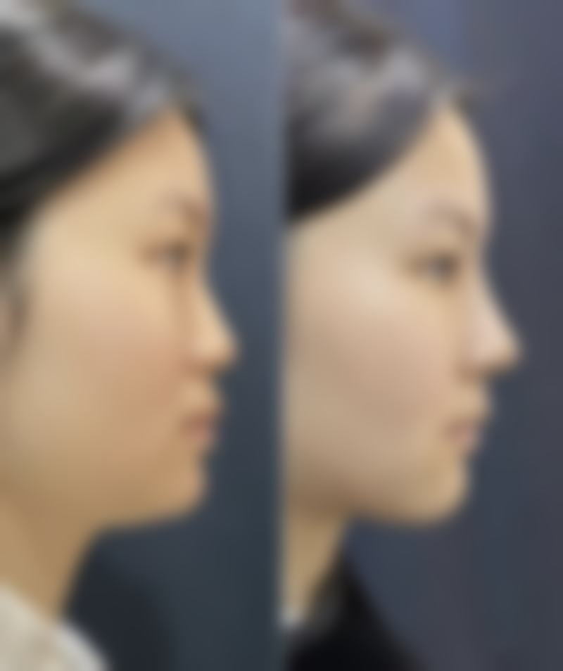 综合隆鼻会用到哪些材料？