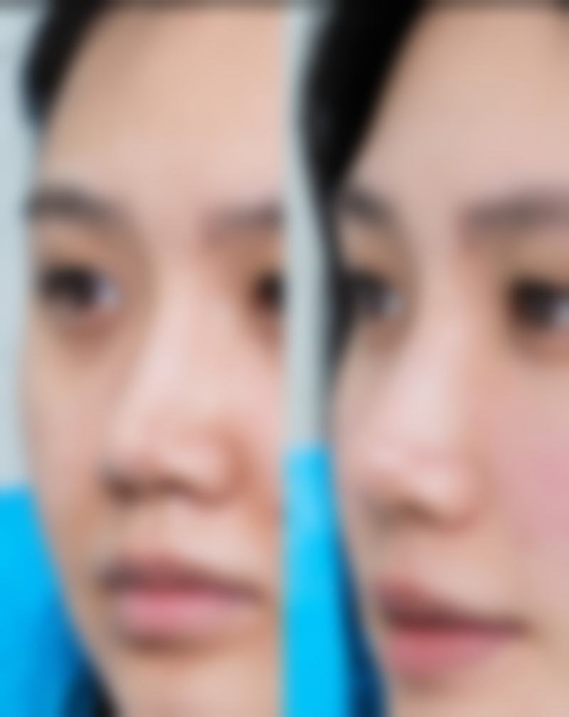 综合隆鼻是怎么样？一次手术调整多部位，从术式材料到恢复价格，一文全了解！ 