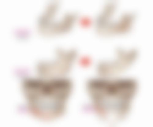 理疗在疤痕疙瘩治疗中的应用