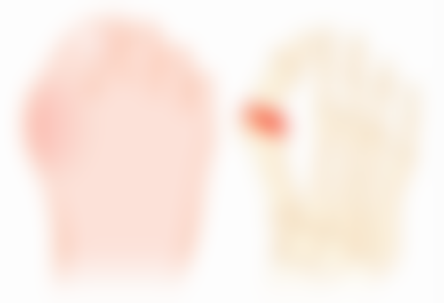 疤痕增生按摩能消除吗？单独按摩难消除，结合多疗法可缓解，还有这些注意事项！ 