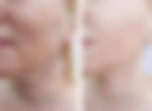 术中操作：精细技艺塑造理想毛发