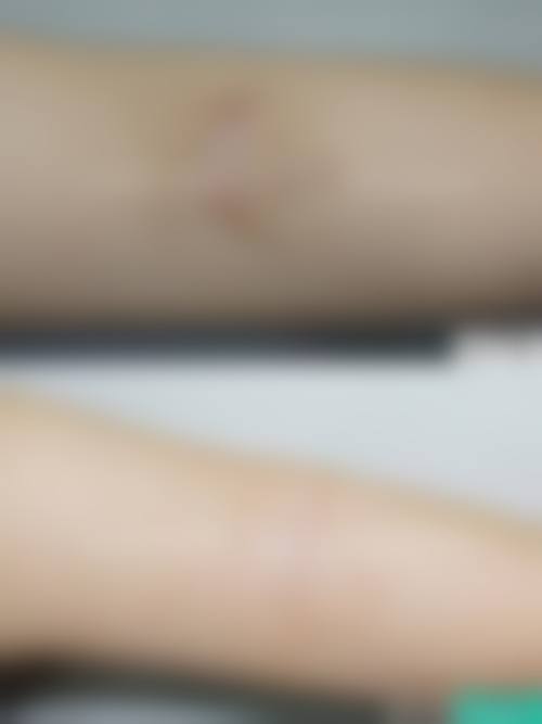 四、陕西省核工业二一五医院烧伤整形科特色项目