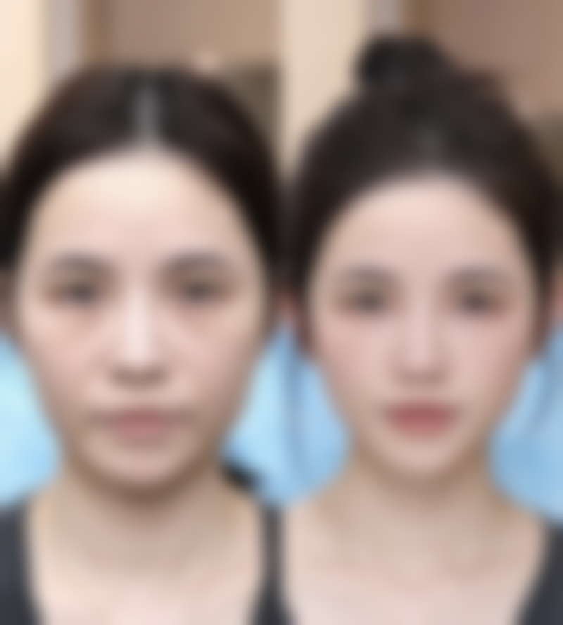 影响假体取出疼痛程度的因素