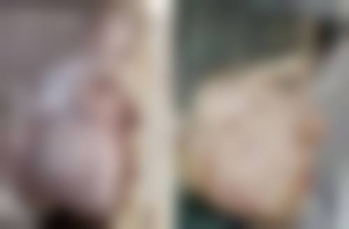 怎么做双眼皮的效果？非手术与手术方案大揭秘，不同术式效果各有千秋！ 