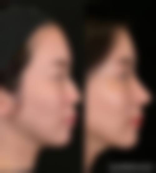 五、濮阳第二人民医院整形美容科收费价格表