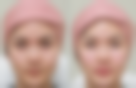 手术技术对全割双眼皮成效的影响