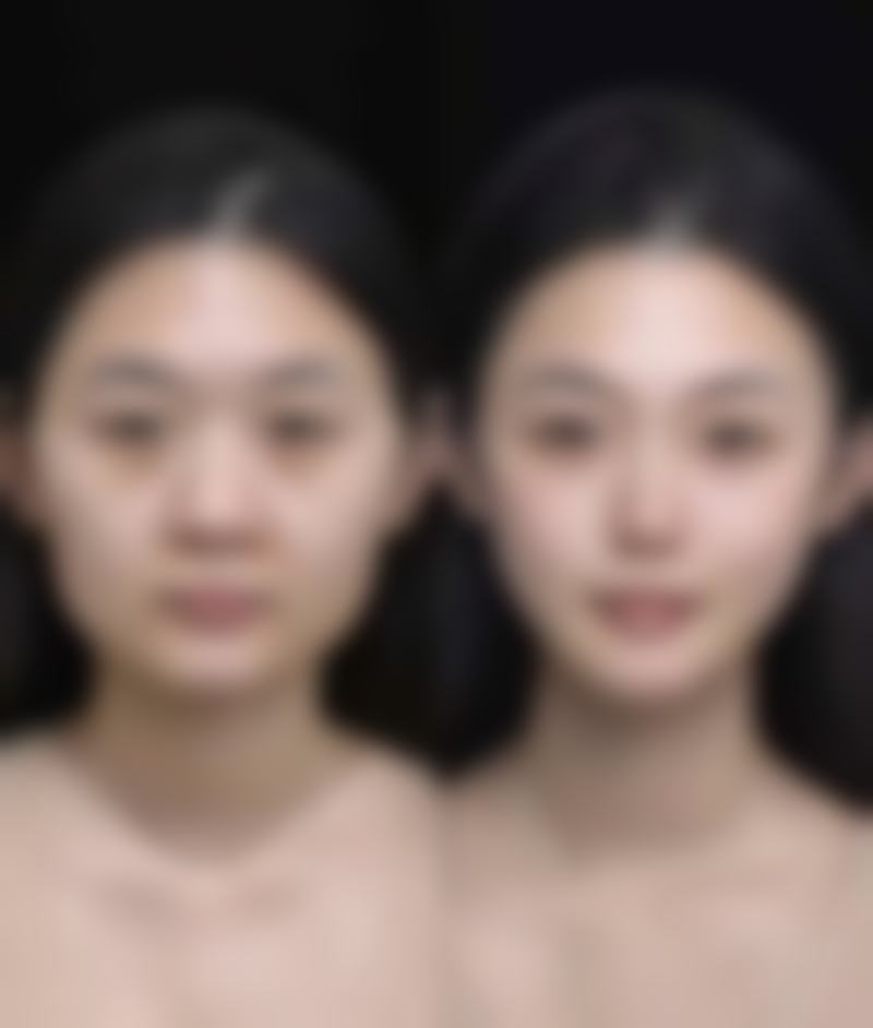 轻症蛙腮消失时间