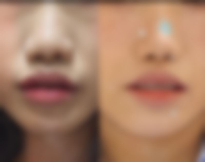 做完双眼皮多久不能吃辣？受多因素影响，时间在1个月到6个月不等，需结合恢复定！ 