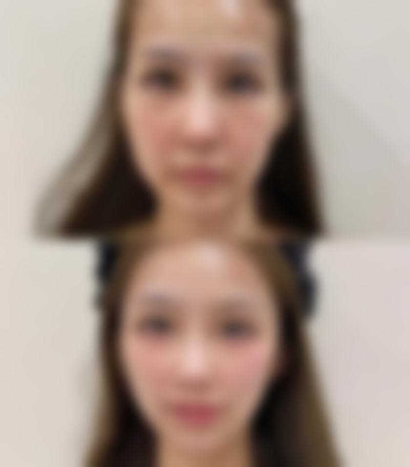 黄金眼霜去眼袋的实际成效