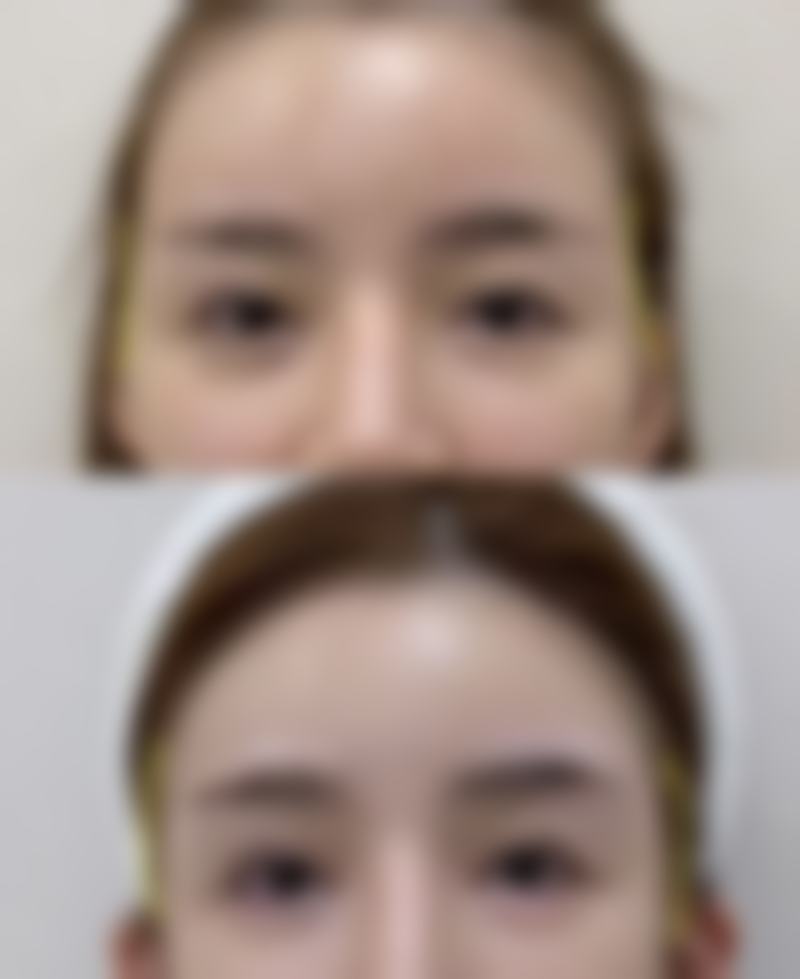 割双眼皮对以后有什么影响吗？可能出现感染、形态不佳等状况，规范操作可降低风险！ 