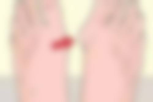 早期轻微疤痕增生使用积雪苷霜软膏的成效