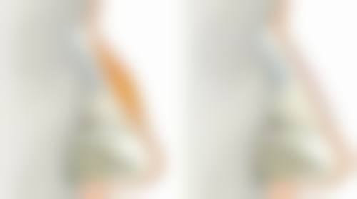 疤痕增生可以用积雪苷霜软膏吗?早期轻微增生可用，重度需联合治疗，使用还有这些注意事项！ 