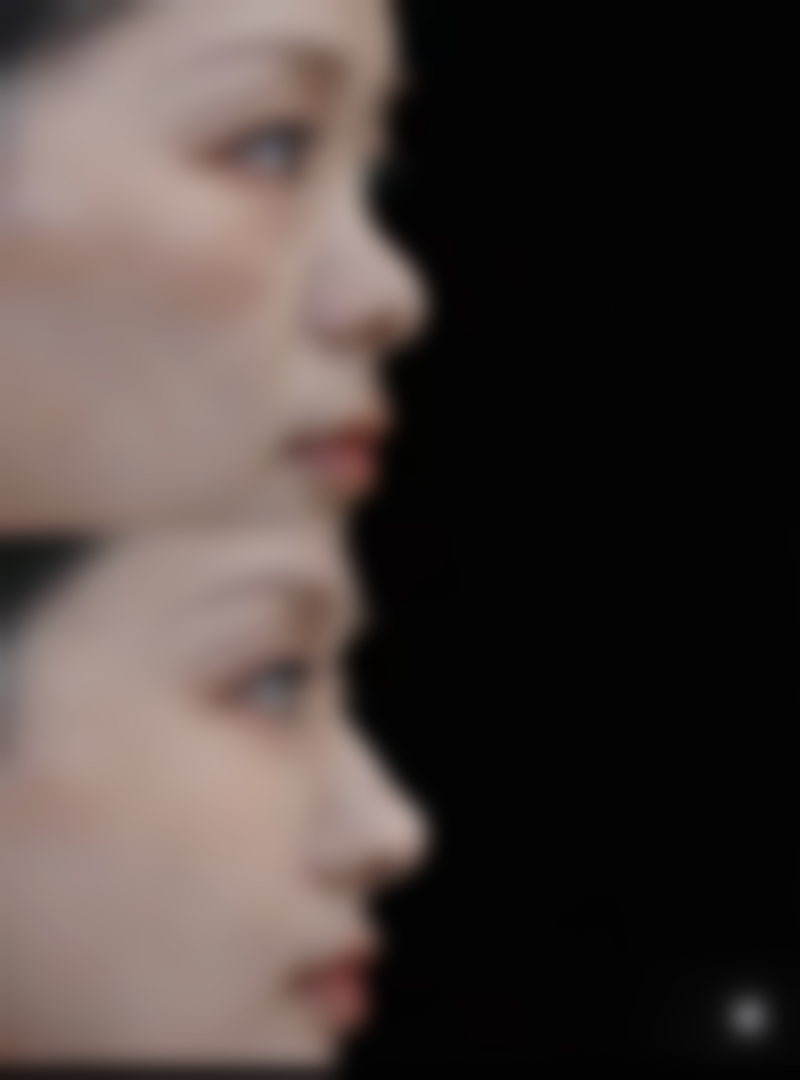 早拆埋线对眼皮松弛的影响较小