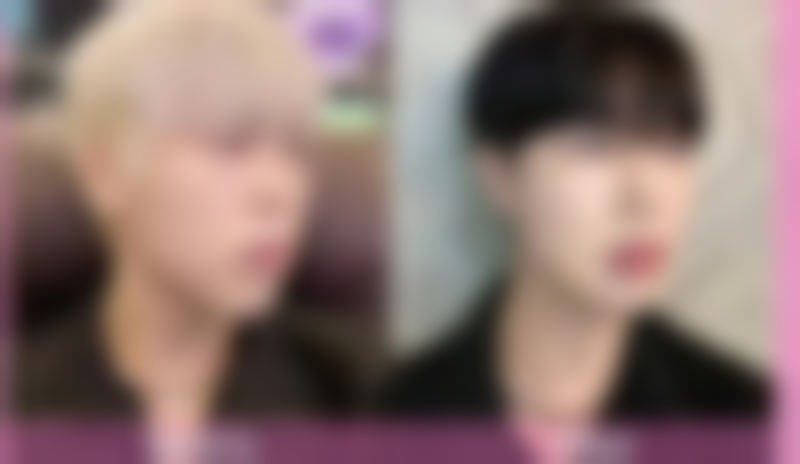 填充治疗红色凹陷疤痕