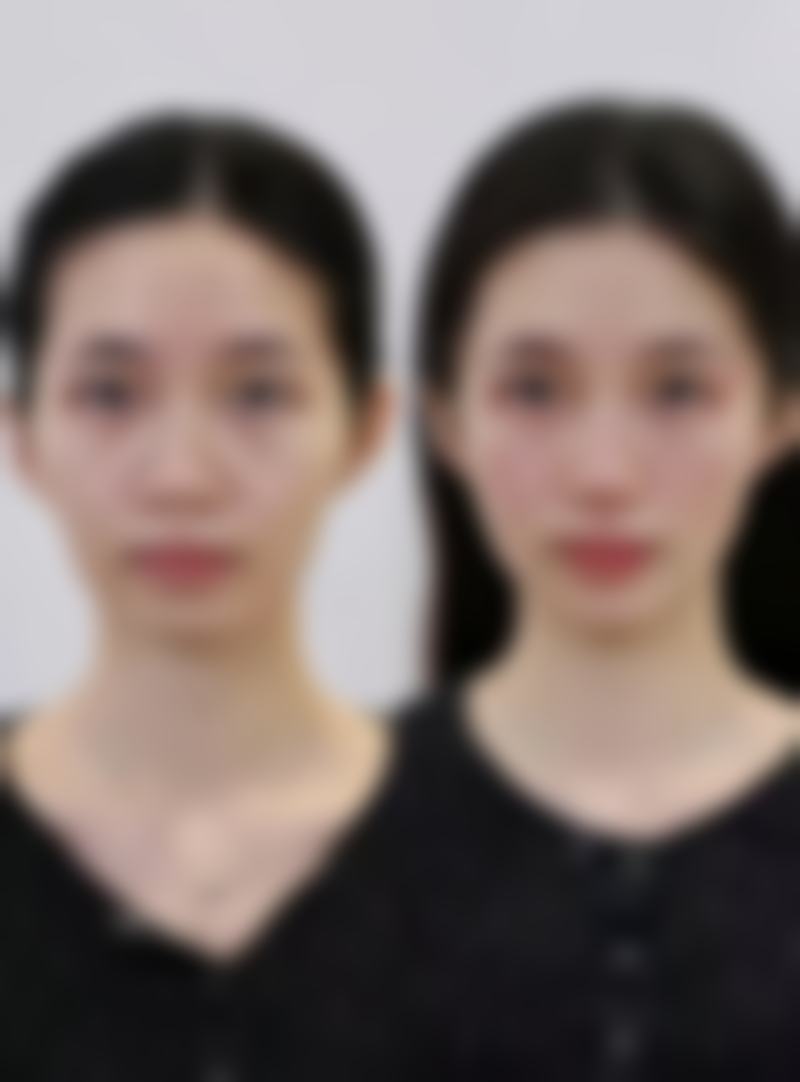 去除下眼袋后的注意事项