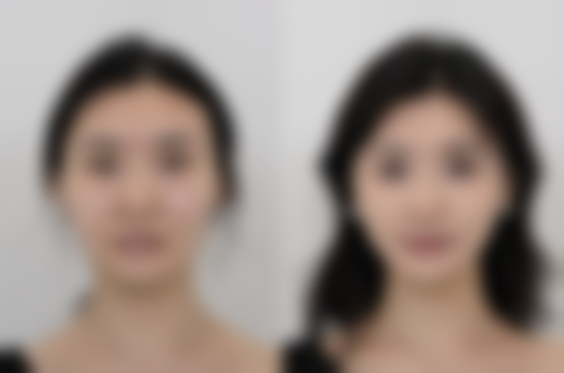 日常护理去除下眼袋