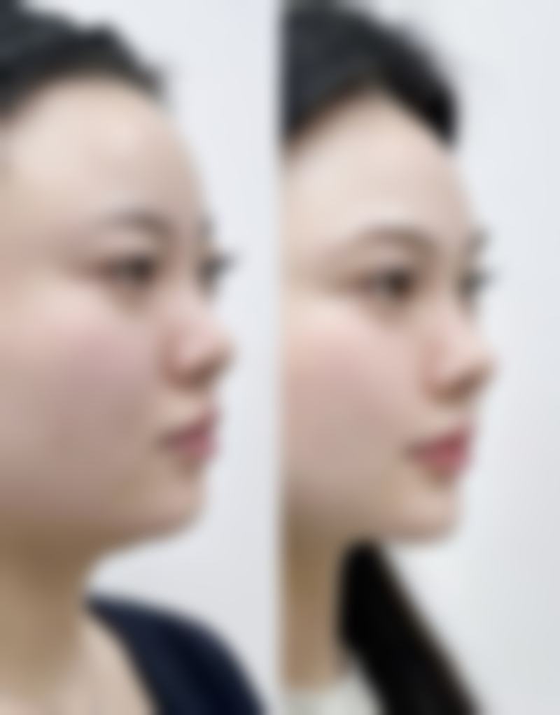 用什么能去除疤痕？药物、物理、手术治疗方法大揭秘，助您淡化修复疤痕！ 