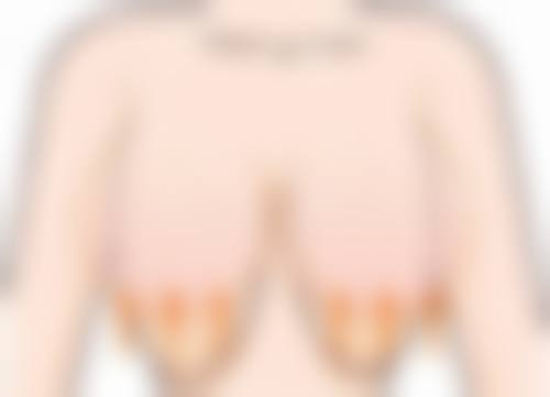 硅胶隆鼻多久消肿自然？多数人1个月左右基本恢复，3个月左右完全消肿恢复自然！ 