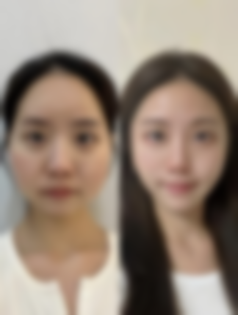 瘦脸针多久后成效更明显：个体差异影响