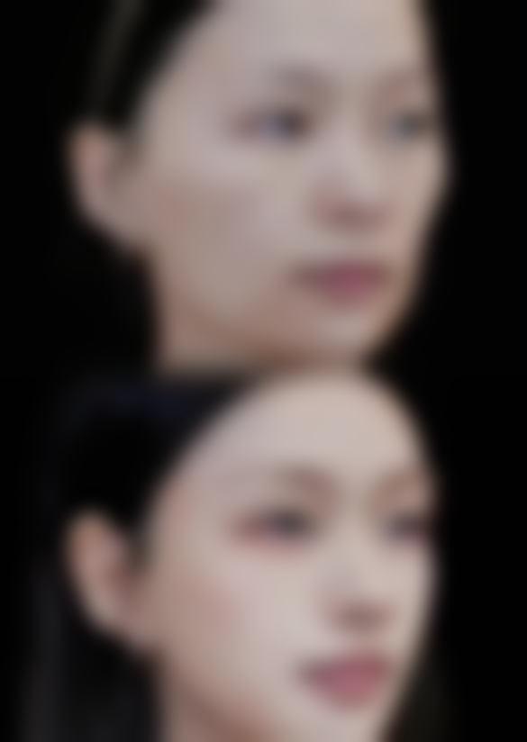 治疗疤痕体质疤痕增生的方法