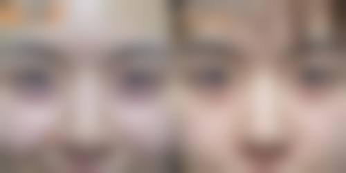 眼袋形成的原因