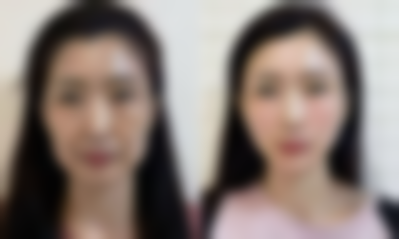 割双眼皮修复期的注意事项