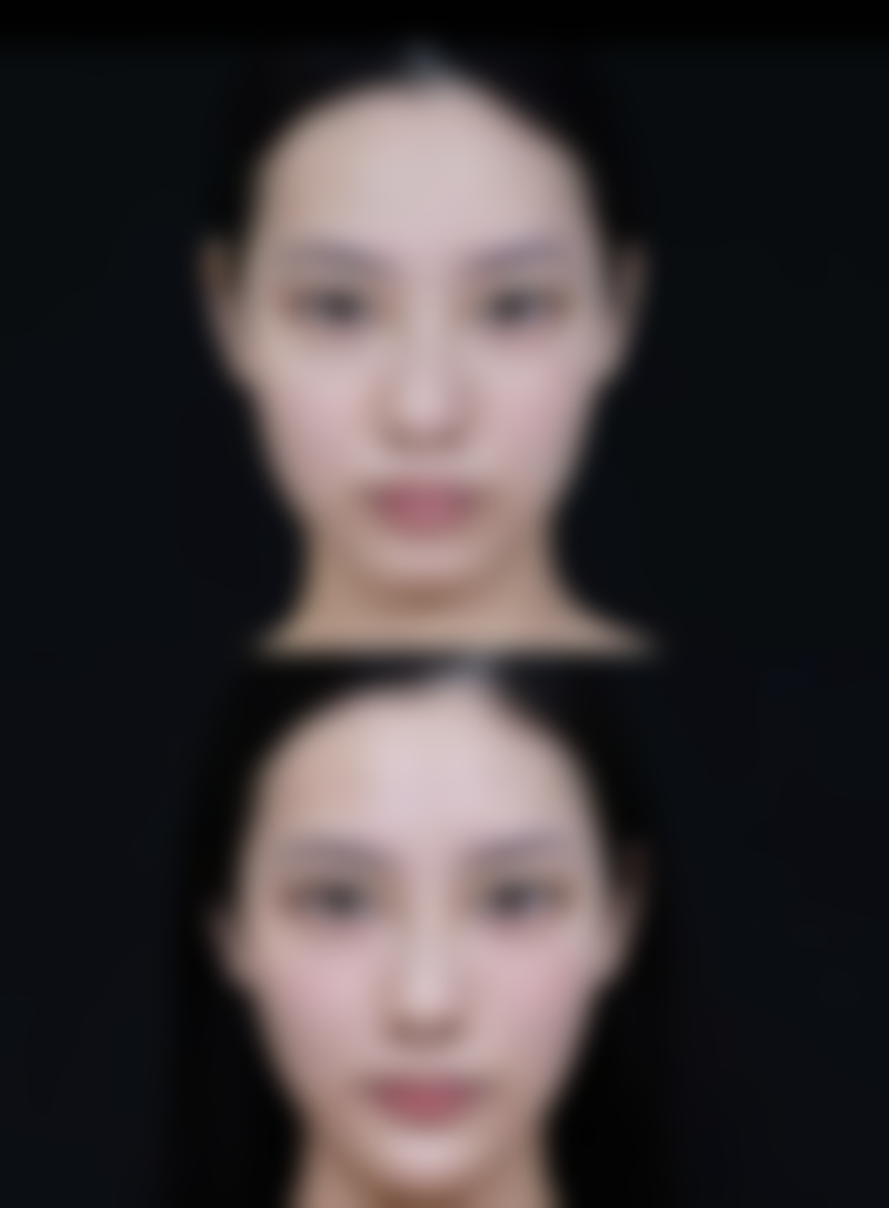 正确去除眼袋的方法