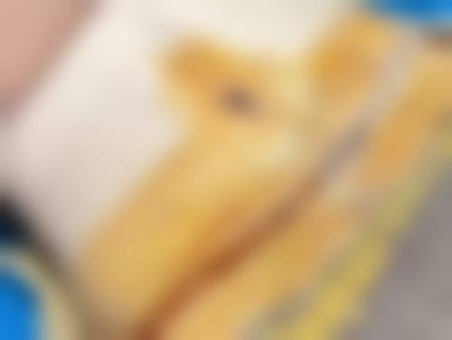 左眼袋一直跳的重度情况及进阶治疗