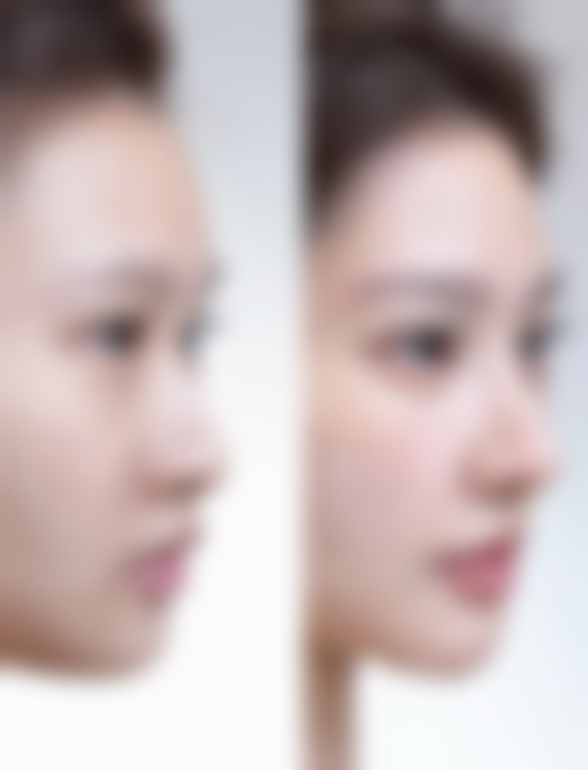 影响抽脂填胸修复时间的因素