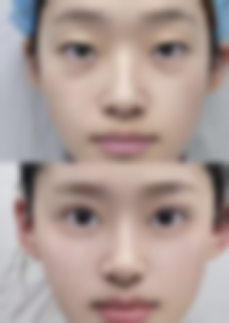 五、诸暨欧莱美整形彭思进医生技术怎么样？