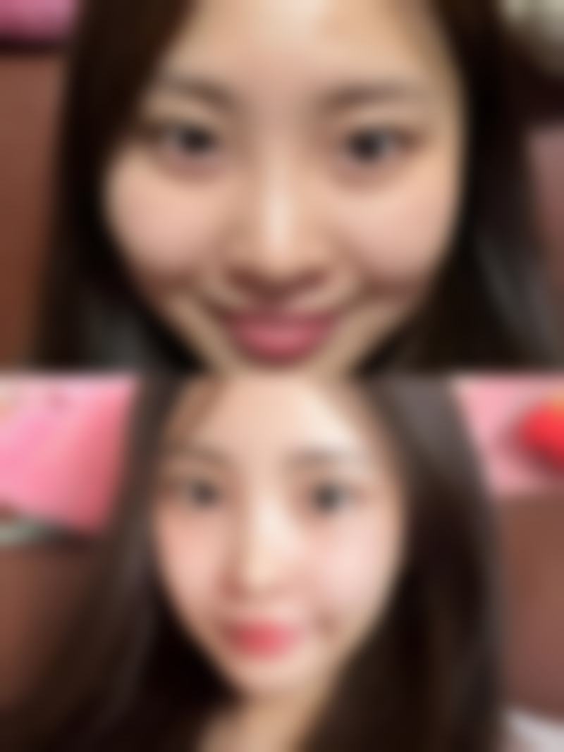 冰敷按摩，促进眼部血循环