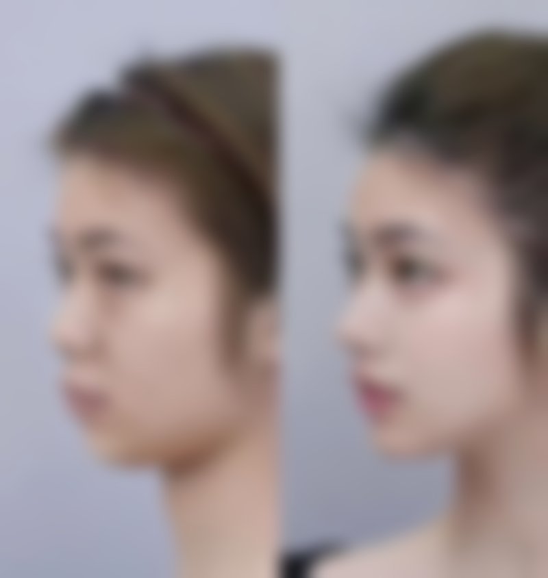 怎么样才能有效的去除眼纹眼袋？日常护理、医美手段双管齐下，助您重焕眼部年轻光彩！ 