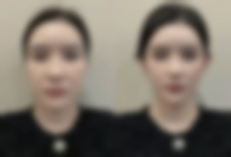 影响光电治疗疤痕修复成效的因素