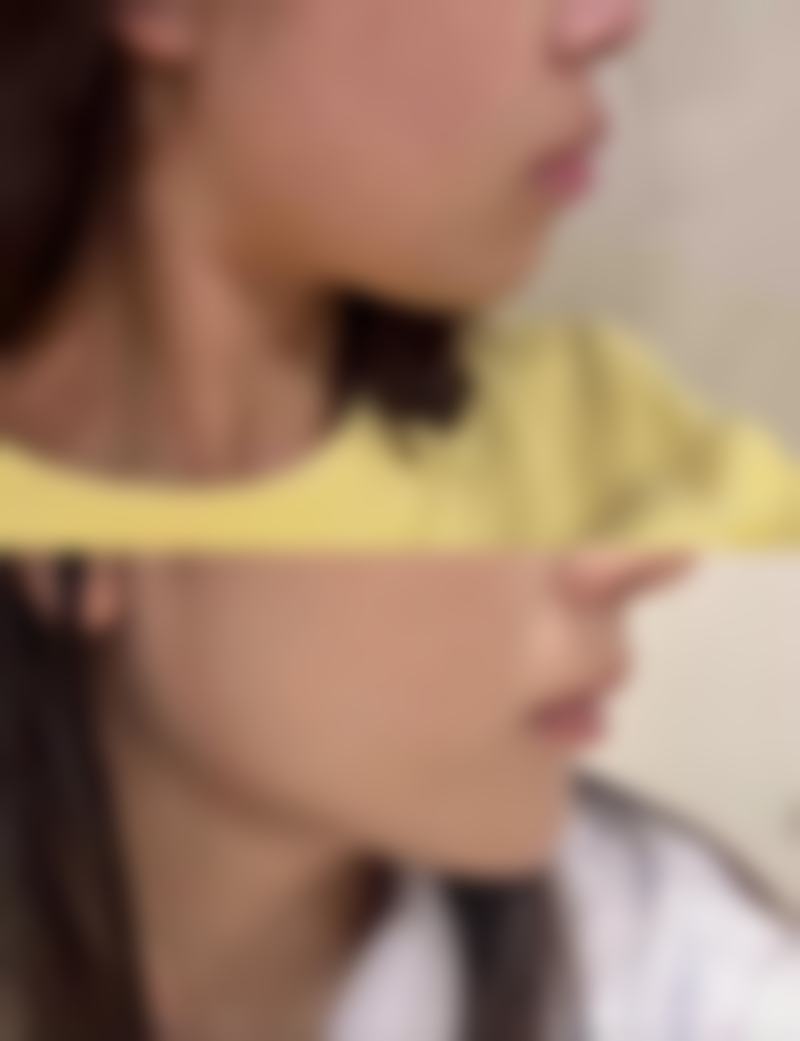 激光治疗：精细效率高的疤痕修复手段