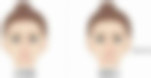 专精医生：双眼皮成效的关键因素