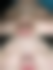 激光治疗:温和修复肌肤“瑕疵”