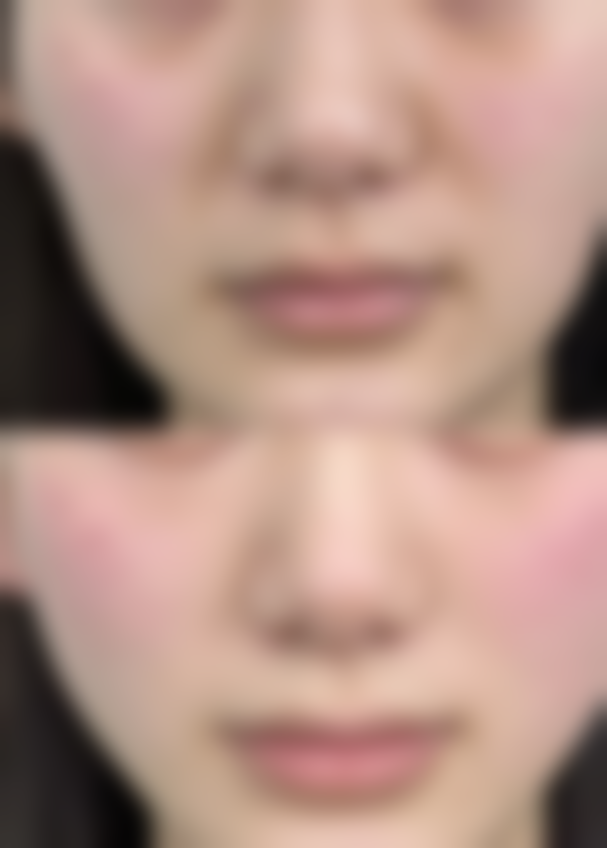 非手术医美：安心便捷的去眼袋选择